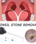 Manual Vacuum Tonsil Stone Remover Kit With Safe PVC Glass Tube For Adults Dental Suction Mouth Cleaner Right Angle Design image