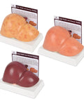 Hella Realistic Silicone Liver Anatomy Set Featuring Three Straight Up Life Size Medical Teaching Models with Normal And Fatty Liver Versions on display.