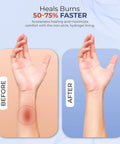 BurnFIX Burn Kit First Aid 25pcs; two-panel forearm burn before and after healing panels