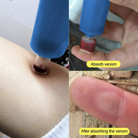 Using Go To Outdoor Bite And Sting Suction Kit for extracting venom from a bug bite on skin with pump and cup detail.
