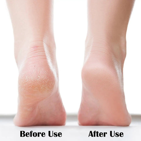 Before and after use of Glass Foot File With Fine Grinding Points For Dead Skin Removal And Calluses, Portable Pedicure Tool For Wet Or Dry Feet.