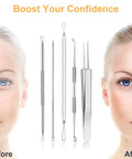 9-In-1 Pimple Popper Kit With 16 Precision Heads, Blackhead Remover Tools Set, face before and after treatment results