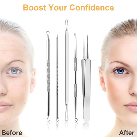 9-In-1 Pimple Popper Kit With 16 Precision Heads, Blackhead Remover Tools Set, face before and after treatment results