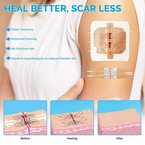 16 Pack Zip Stitches Wound Closure Kit With Butterfly Bandages shown on arm for painless stitchless healing
