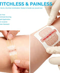 Applying 16 Pack Zip Stitches Wound Closure Kit With Butterfly Bandages And Suture Options on arm, showing stitchless closure.
