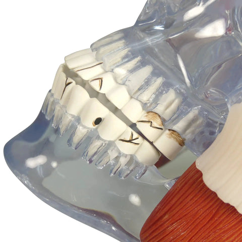 Close-up of Temporomandibular Joint TMJ Model With Pathologies For Human Anatomy And Physiology Education showing teeth wear.