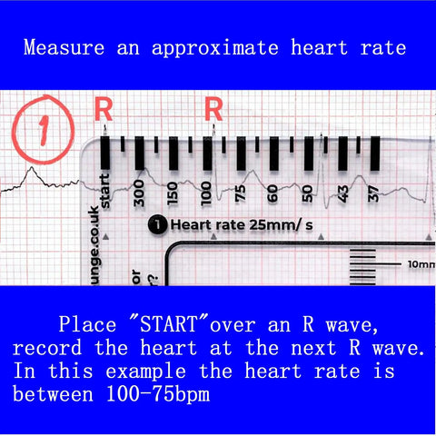 Triple Pack ECG 7 Step Ruler Set For ECG EKG Interpretation, Transparent Plastic Calipers Measuring Tool in use on EKG tracing