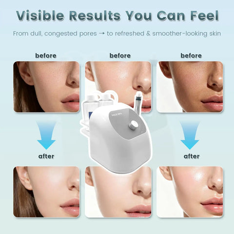 At Home Pro Grade Hydro Facial System With Hydrogen Oxygen Therapy Hydrodermabrasion And Pore Vacuum Cleaner results image
