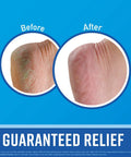 Before and after feet comparison using Working Hands Hand Cream And Healthy Feet Foot Cream Duo For Extremely Dry Cracked Hands And Feet