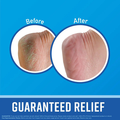 Before and after feet comparison using Working Hands Hand Cream And Healthy Feet Foot Cream Duo For Extremely Dry Cracked Hands And Feet