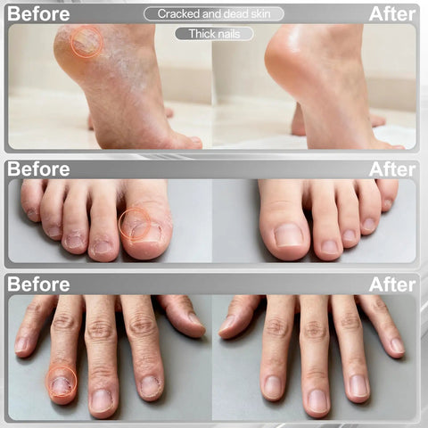 Before and after photo showcasing foot and hand transformations using Cordless Electric Nail File Drill With Rugged 2000 Mah Battery And Bright Led Lamp Real Deal Professional Manicure Pedicure Kit Featuring Ten Heavy Duty Grinding Heads For Gel Polish Removal Callus Buffing And Zero Hassle Salon Vibes At Home.