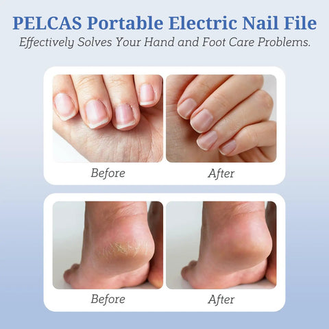 Before and after images showing results of PELCAS Portable Electric Nail File on hands and feet, illustrating effective nail care.