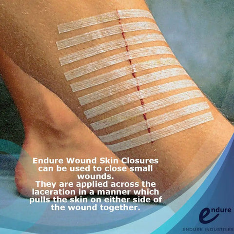 Reinforced Wound Closure Strips Half Inch By Four Inch For Small Cuts And Lacerations, 30 Total, applied over a leg wound
