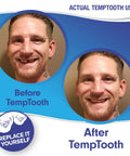 Before and after results of using Temporary Tooth Replacement Kit For A Confident Smile That Looks Natural And Discreet Patented And Trusted