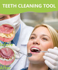 Pro At Home Dental Cleaning Kit With Stainless Steel Dental Pick And Tartar Remover used by a dentist, before and after results shown.
