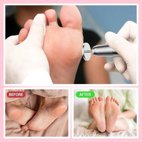 60 Pcs Replacement Sandpaper Discs With 25mm Metal Mandrel Bit For Electric Foot File, before and after callus removal results