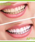 Comparison of teeth before and after using Pro At Home Dental Cleaning Kit With Stainless Steel Dental Pick And Tartar Remover.