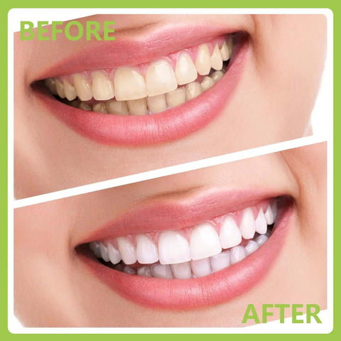 Comparison of teeth before and after using Pro At Home Dental Cleaning Kit With Stainless Steel Dental Pick And Tartar Remover.