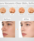 Before and after results using Face Pore Vacuum Blackhead Remover With 3 Suction Levels And 6 Interchangeable Probes, focus on clear nose