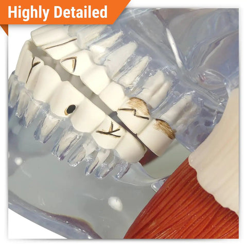 Close-up of Temporomandibular Joint TMJ Model With Pathologies For Human Anatomy And Physiology Education showing teeth detail.
