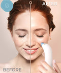 Blue Blackhead Remover Facial Cleanser Vacuum with five suction levels used on woman's face showing before and after results.