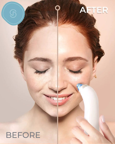 Blue Blackhead Remover Facial Cleanser Vacuum with five suction levels used on woman's face showing before and after results.