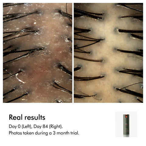 Close-up of scalp before and after using Amino11 Leave-In Scalp Bubble Treatment With Barley Grown On Farms over 84 days