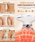 4 In 1 Body Sculpting Machine For Cellulite Reduction And Stretch Mark Reduction Anti Cellulite Massage Tool With Lymphatic Drainage Skin Tightening And Firming For Back Belly Arms And Legs White showing results on abdomen