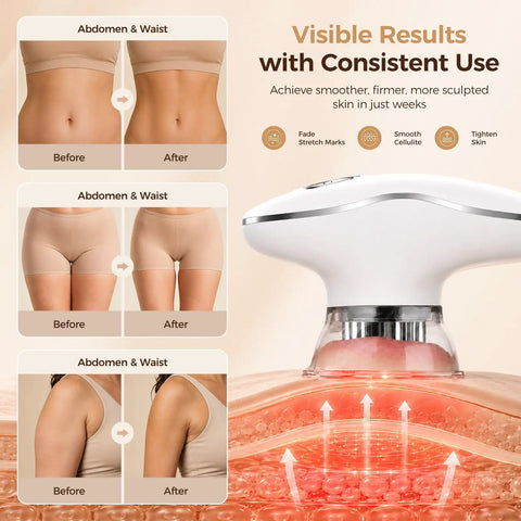 4 In 1 Body Sculpting Machine For Cellulite Reduction And Stretch Mark Reduction Anti Cellulite Massage Tool With Lymphatic Drainage Skin Tightening And Firming For Back Belly Arms And Legs White showing results on abdomen