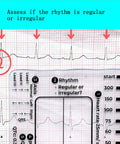 3 Pack ECG Seven Step Ruler Set on EKG paper, showing calipers for quick ECG interpretation with clear reference points.