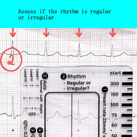 3 Pack ECG Seven Step Ruler Set on EKG paper, showing calipers for quick ECG interpretation with clear reference points.