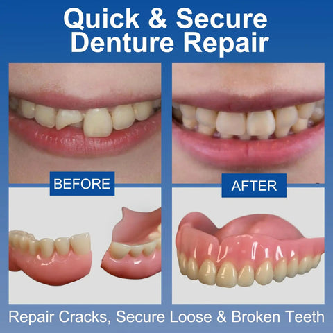 Before and after using Instant Bonding Denture Glue For At Home Fixes, Ultra Strong Adhesive That Secures Loose Or Broken Teeth.