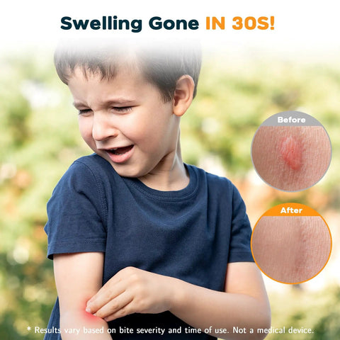 Bug Bite Venom Extractor Tool 2 Pack For Instant Itch Relief And Swelling, Portable First Aid Sucker For Hiking And Camping, Sting Relief In 30 Seconds, Summer Essentials For Kids And Adults boy holding bitten arm