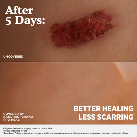 Comparison of uncovered wound and covered by Ultra Thin Hydrocolloid Bandages For Advanced Wound Healing, 100 Percent Waterproof Protection, Less Scarring Than Uncovered Wounds, Pro Heal Five Day Coverage, One Size, 10 Count after 5 days.