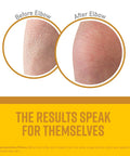 Before and after images of elbow using Skin Repair Body Lotion For Extremely Dry Skin Unscented Quick Absorbing Non Greasy Moisturizer 12 Ounce