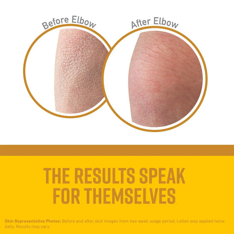 Before and after images of elbow using Skin Repair Body Lotion For Extremely Dry Skin Unscented Quick Absorbing Non Greasy Moisturizer 12 Ounce