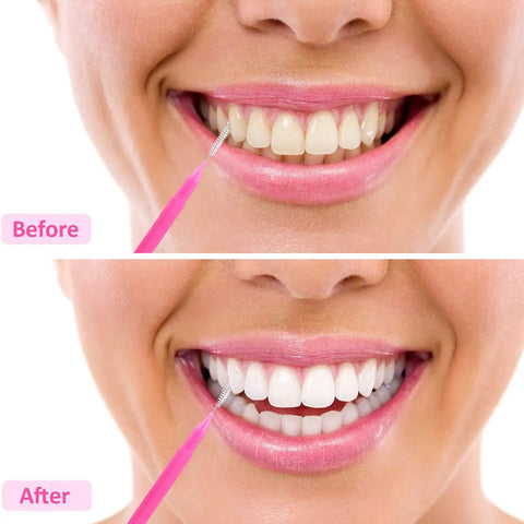 Before and after using Interdental Brush And Toothpick Kit For Braces 100 Pack In Bright Colors With 11 Mm And 13 Point 5 Mm Sizes.