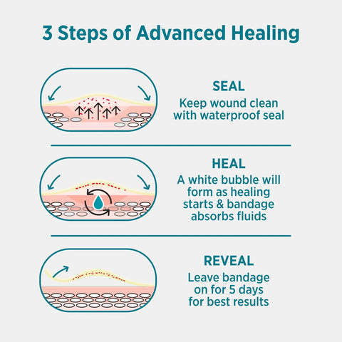 3 steps of using Ultra Thin Hydrocolloid Bandages for advanced wound healing, highlighting seal, heal, reveal stages