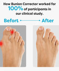 Bunion Corrector for Overlapping Big Toes and Hallux Valgus Pain Relief, before and after image showing toe improvements