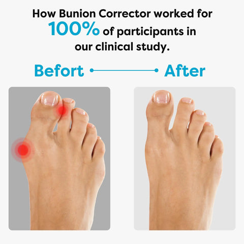 Bunion Corrector for Overlapping Big Toes and Hallux Valgus Pain Relief, before and after image showing toe improvements