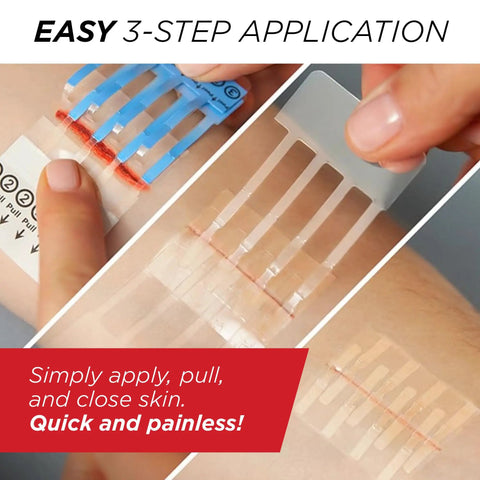 Emergency Laceration Closure Kit With Three Individually Packaged Closures for quick wound repair without stitches application