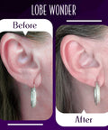 Comparison of ears with Clear Latex Free Ear Lobe Support Patch For Pierced Ears That Instantly Lifts And Protects Prevents Torn Or Stretched Lobes Nearly Invisible Earring Back Alternative For All Styles And Sizes 60 Patches