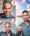 Before and after using 6 Pack Minoxidil For Guys Hair Growth Treatment With Extra Strength Five Percent Liquid Solution Six Month Supply Includes Dropper Applicator And Microneedle Roller For Easy Daily Scalp Application
