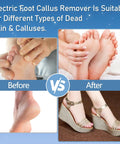 Before and after comparison using Waterproof Electric Foot Callus Remover With Three Roller Heads Two Speed Settings Battery Display