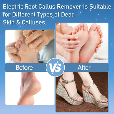 Before and after comparison using Waterproof Electric Foot Callus Remover With Three Roller Heads Two Speed Settings Battery Display