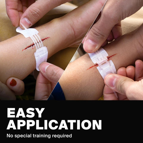 Zip Stitch wound closure strips applied to a forearm cut; white adhesive bandage with multiple thin strips