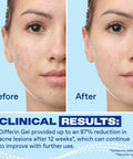 Before and after results using Acne Treatment Gel With 0.1 Percent Adapalene Retinoid, showing reduced acne on skin.