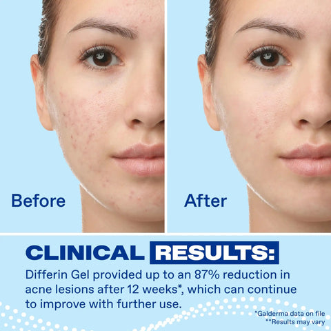 Before and after results using Acne Treatment Gel With 0.1 Percent Adapalene Retinoid, showing reduced acne on skin.