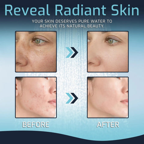Before and after images showing skin improvement with High Output Shower Filter Head For Hard Water Removes Chlorine And Heavy Metals.