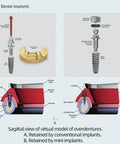 Diagram of mini dental implants showing comparison with conventional implants, including cross-sectional views and components.